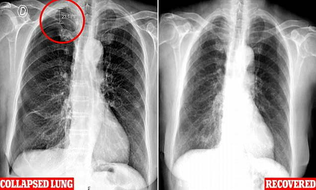 Acupuncture Caused an Elderly Woman's Lung to Collapse 1