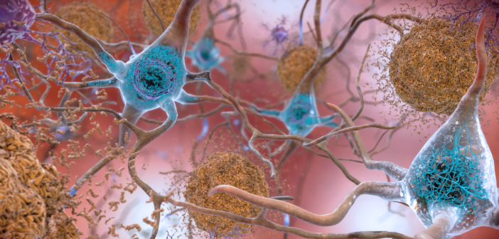 High Levels of ‘Bad’ Cholesterol Tied to Early-Onset Alzheimer’s 1