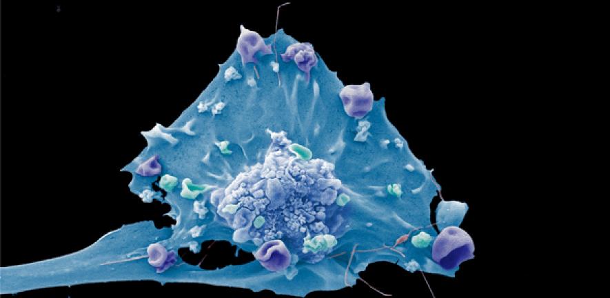 Researchers find out new genetic link to premenopausal breast most cancers