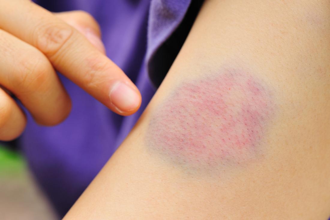 Home treatments to treat and relieve bruises