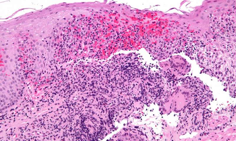 Plant-based totally food plan successfully sends Crohn’s disorder into remission 1