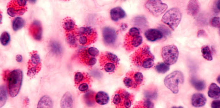 Regeneron/Sanofi’s antibody underwhelms in allergies observe