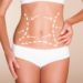 What You Need To Know About Liposuction