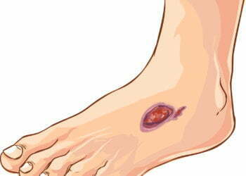 Study: Spinal Cord Stimulation May Relieve Diabetic Neuropathy