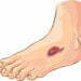 Study: Spinal Cord Stimulation May Relieve Diabetic Neuropathy