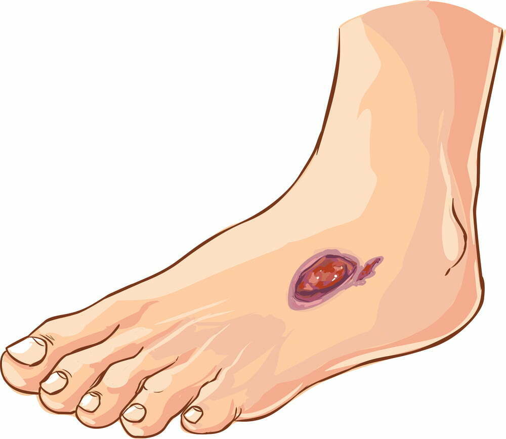 Study: Spinal Cord Stimulation May Relieve Diabetic Neuropathy 1