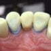 Temporary Dental Bridge For a Longer Term Smile