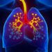 Is Asthma a Lung Disease?
