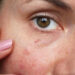 Face Redness Home Remedies for Instant Results
