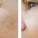 Laser Treatments for Skin Rejuvenation, Skin Pigmentation Removal, Wrinkles